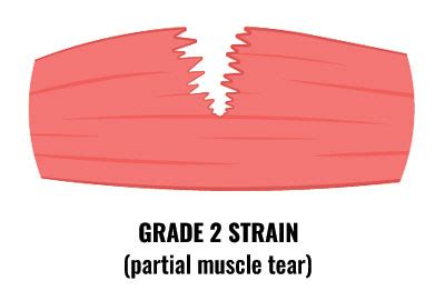 what test will show a muscle tear|grade 1 muscle strain symptoms.